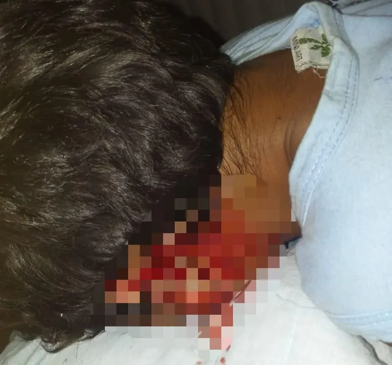 Criança é gravemente ferida por cão de rua em Colatina
