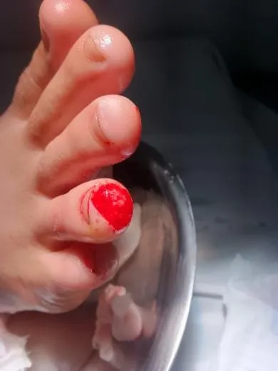 Ataque de piranhas deixa banhistas feridos na Cachoeira do Onze, em Colatina